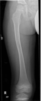 Paediatric Femur Fracture 1 year